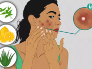 रातों-रात मुंहासों को कैसे दूर करें – पांच आसान घरेलू उपाय Pimple hatane ka tarika gharelu upay aur nuskha