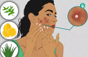 रातों-रात मुंहासों को कैसे दूर करें – पांच आसान घरेलू उपाय Pimple hatane ka tarika gharelu upay aur nuskha